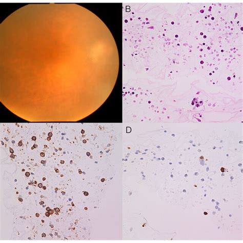 Representative Case 1 With Vitreoretinal Lymphoma Showing Negative Cell Download Scientific