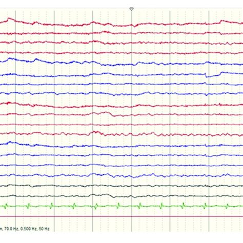 Initial Electroencephalogram Eeg Shows Mild Encephalopathy