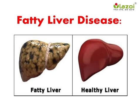 PPT - Fatty Liver Disease: Information on symptoms, causes and ...