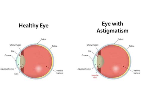 Astigmatism Causes Symptoms Diagnosis And Treatment