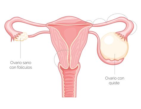 Endometriosis