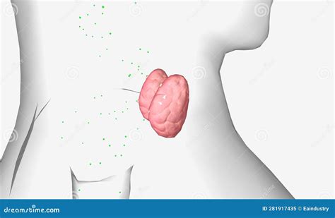 Normal Parathyroid Glands With Parathyroid Adenoma Cartoon Vector