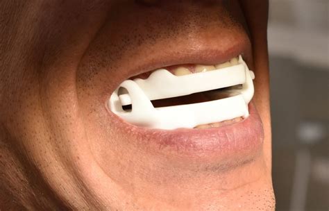 Qué son los dispositivos de avance mandibular DAM OrthoApnea