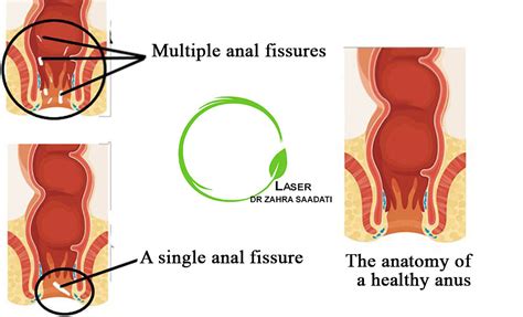 Anal Fissure Surgery Dr Zahra Saadati Laser Surgery