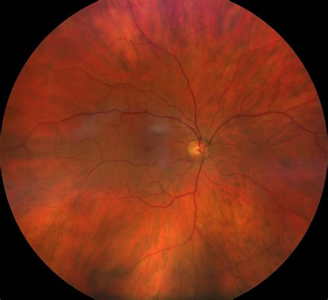 Retinal Detachment Symptoms Causes And Treatment Options