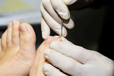 Consulta De Dermatologia Para Unhas Clínica Eclat Tratamento Para