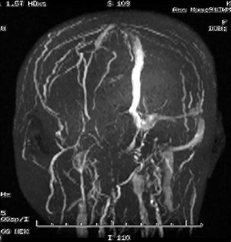 Mri Showing Right Transverse And Sigmoid Sinus Thrombosis Up To The