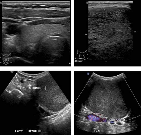 Thyroglossal Duct Cyst Radiology Cases