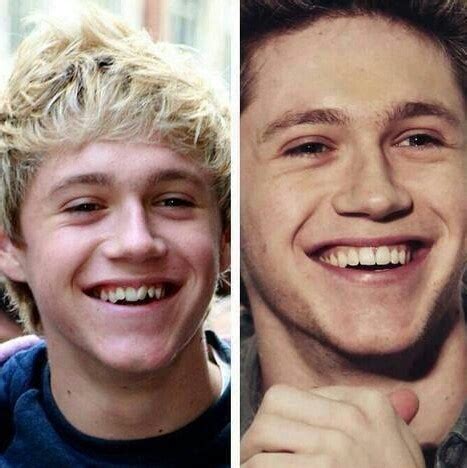 His Smile Was Perfect Before The Braces Cantores Niall Horan Looks