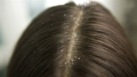 Dandruff Causes Symptoms Treatment And Prevention