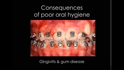 Consequences Of Poor Oral Hygiene Braces Youtube