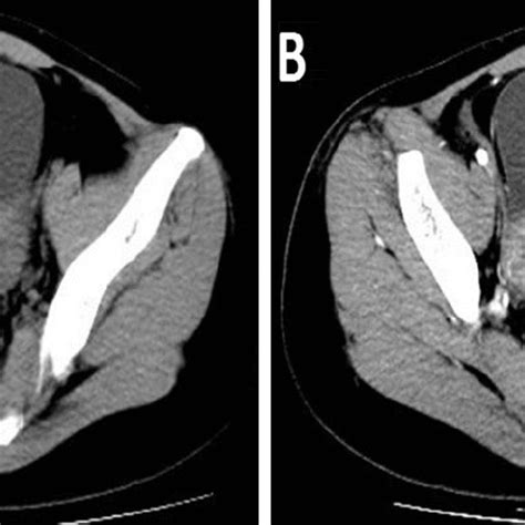 A Year Old Female With Pelvic Tuberculosis Non Enhanced Ct Scan Of