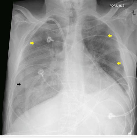 Portable Chest X Ray 14 Days After Admission Showing Partial Interval