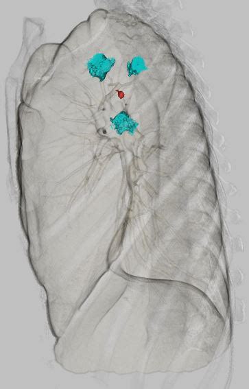 VAL MAP Virtual Assisted Lung Mapping 呼吸器外科 倉敷中央病院