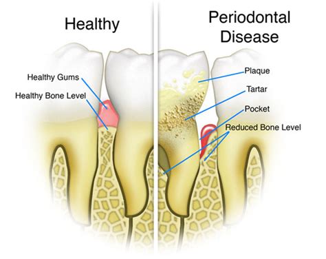 Gum Disease Signs Periodontitis Gum Disease Prevention