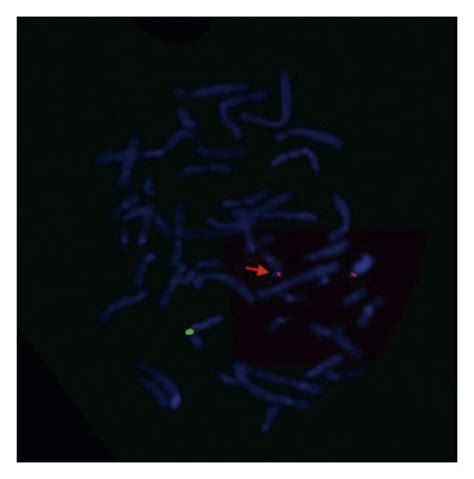 Metaphase Fish Results Of Two Sets Of Probes The Centromere Specific