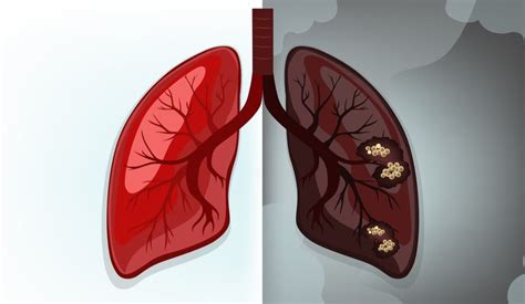 Lung Cancer Symptoms And Treatments Scalar Light