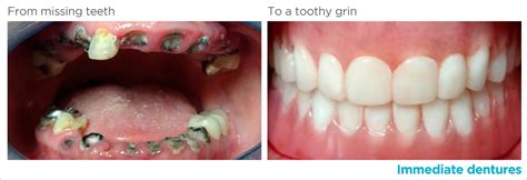 Patient Photos , DDS Dentures + Implant Solutions