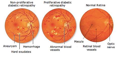 Diabetic Retinopathy - Causes, Symptoms, Treatment | Low Vision Aids