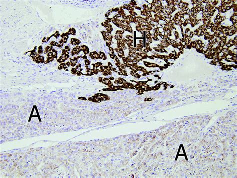 Adrenal Cortical Adenoma In Adrenohepatic Fusion Tissue A Mimic Of Malignant Hepatic Tumor At