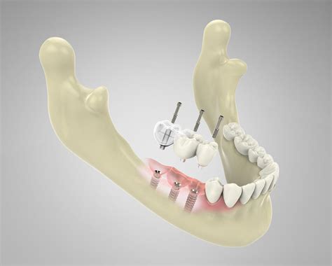 Guide Soins Dentaires Tunisie Implant Facettes Blanchiment