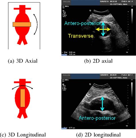 Figure 4 From Semi Automatic Abdominal Aortic Aneurysms Geometry