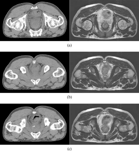 Ct Left And Mri Right Identifying Some Of The Bony Hot Sex Picture