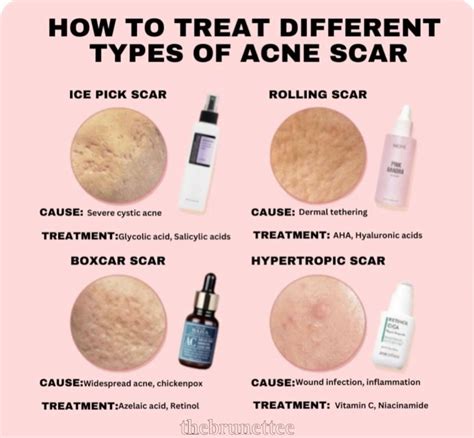 How To Get Rid Of Acne Scars Artofit