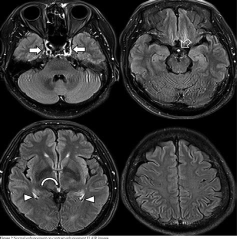 Comparison Of Gadolinium Based T1 Weighted And Flair Mr Sequences For