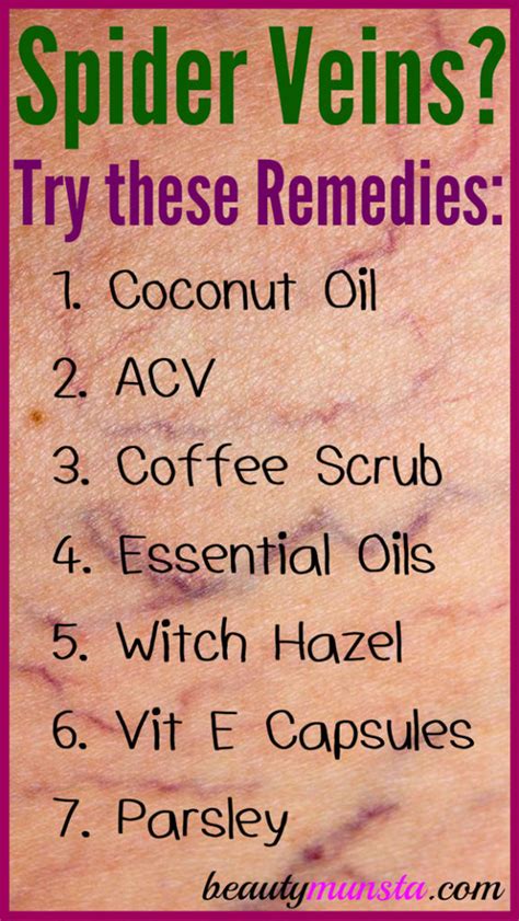 7 Natural Remedies For Spider Veins Beautymunsta Free Natural Beauty Hacks And More