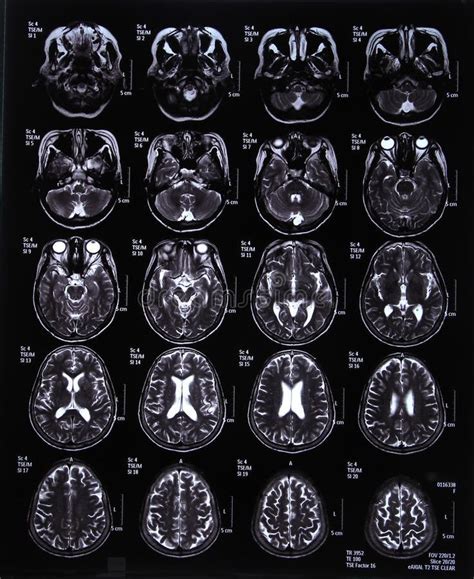 Mri Scan Image Of Brain Stock Photography Mri Scan Brain Images Mri