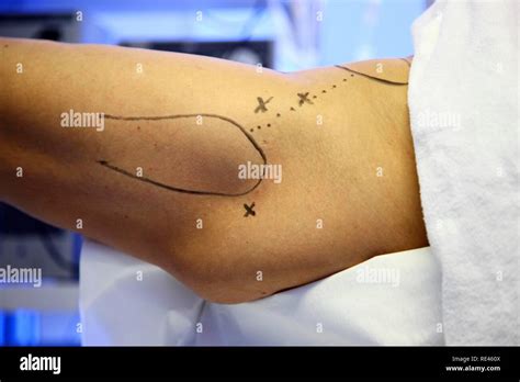 Marking For The Arthroscopic Instruments For Arthroscopy Of The Hip