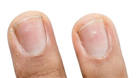 White Nail Spots On Nail Causes And How To Treat Clinikally