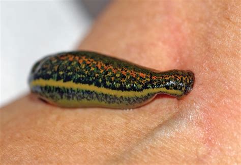 Medicinal Leech Therapy In Plastic Surgery The Pmfa Journal