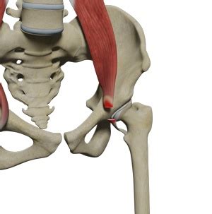 Surgical Release of Iliopsoas Tendon Irvine, CA | Snapping Hip Syndrome ...