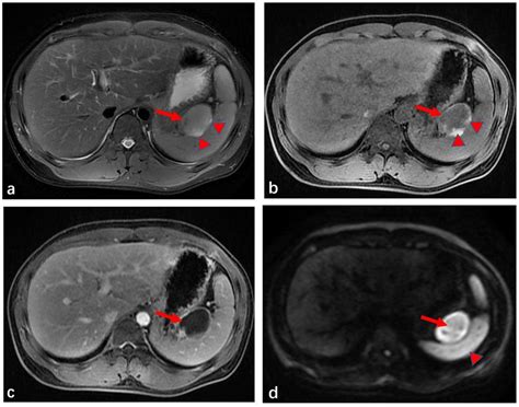 Medicina Free Full Text Radiologic Findings Of Single Accessory