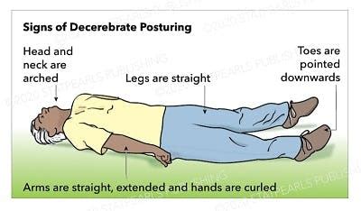 Decorticate And Decerebrate Rigidity | Bruin Blog