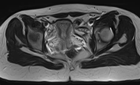 Fibrous Dysplasia Femoral Neck Image Radiopaedia Org