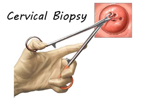 Cervical Biopsy Sukhi Pariwar Clinic