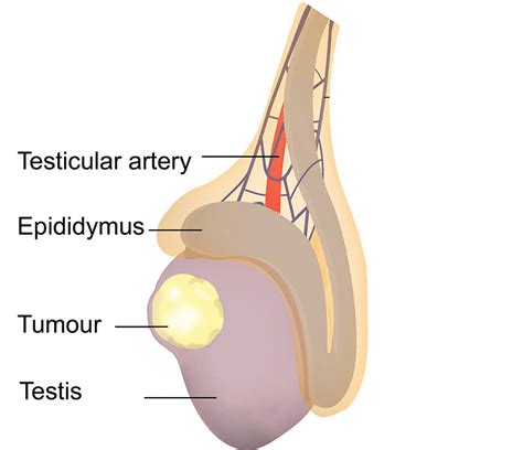 Testicular Cancer Lump On Scrotum