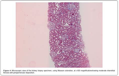 Variability Of Clinical And Paraclinical Manifestations In