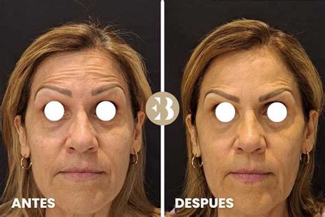 Botox Antes Y Después Todo Lo Que Necesitas Saber Clínica Medicina