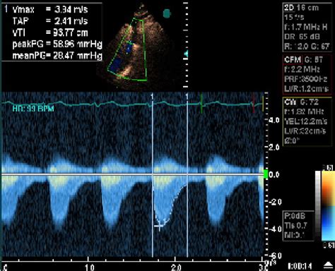 Figure From Doppler Echocardiographic Evaluation Of Patients After