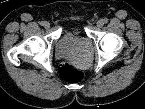 Prostatic Stromal Tumour Of Uncertain Malignant Potential Eurorad