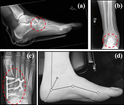 a Navicular stress fracture (Reprinted with permission from Elsevier ...