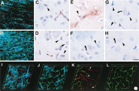 Fibrin Deposition And Ischemic Cell Damage A And B Are Images X Y