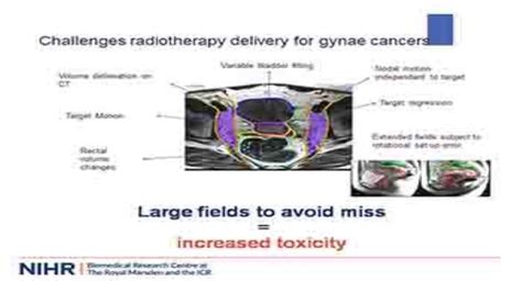 Download Free Medical Radiotherapy Research In Gynaecological Cancers