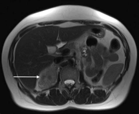 Figure 3 From Retroperitoneal Liposarcoma Mimicking Pheochromocytoma