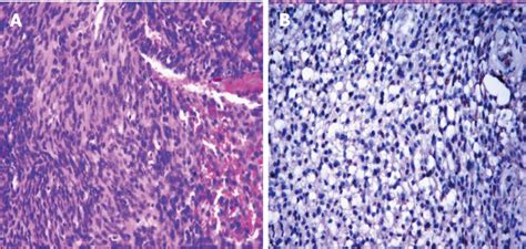 Haematoxylin And Eosin Stained Section Shows Spindle Cells Arranged In