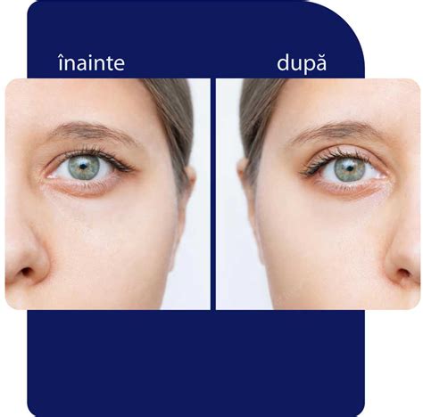 Blefaroplastie Nechirurgicala Lifting Pleoape Esteva Institute